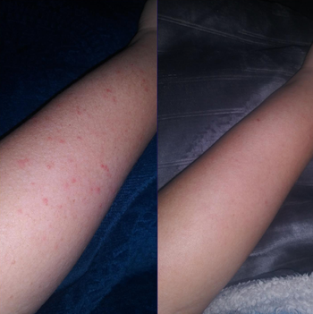 reviewer's arm with red bumps and then an after pic of the same arm clear