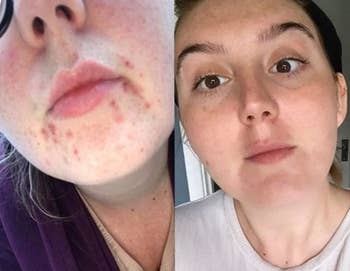 A reviewer with blemishes on their skin before using the moisturizer and with much clearer-looking skin after using it