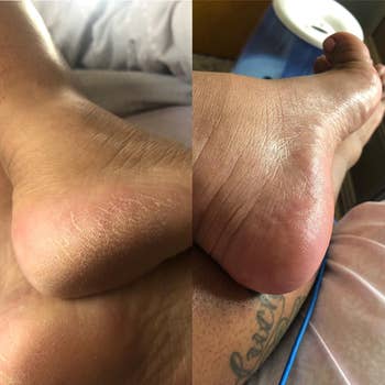 left: reviewer before photo of crusty foot / right: foot looking smooth and soft after using file