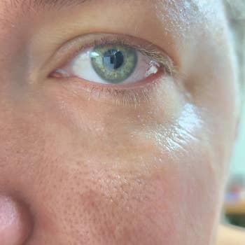 after image of the same person's under eye which is now wrinkle-free and moisturized