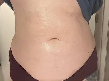 Close-up of a person's midsection with reduced stretch marks