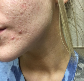 reviewers before photo showing uneven and rough skin