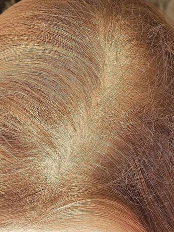 Close-up of a person's scalp and hair, showing hairsbreadth  density and texture