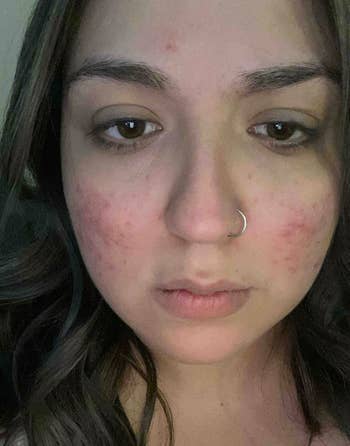 before image of reviewer with rosacea