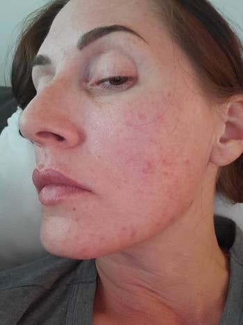 Reviewer before with redness and acnes scarring