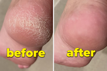 a reviewer's before and after of their cracked heel and then nice and smooth heel