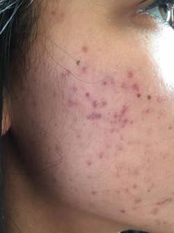 before photo of a reviewer red acne scars on their cheek