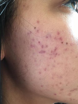before photo of a reviewer red acne scars on their cheek