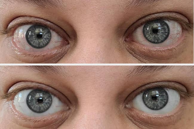 Close-up of a person's eyes going from red and irritated to white and calm