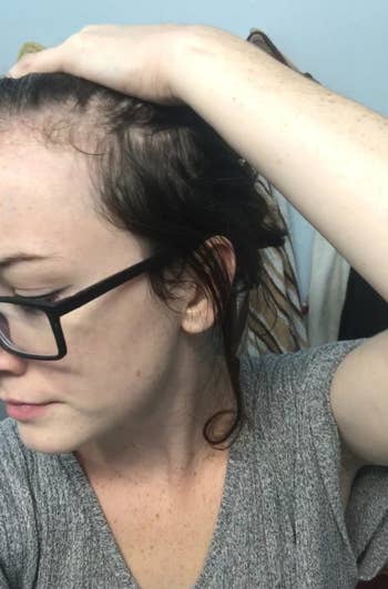 reviewer's earlier  changeable  of their thinning hairsbreadth  with receding hairline