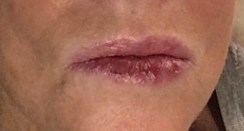 reviewer image of chapped lips