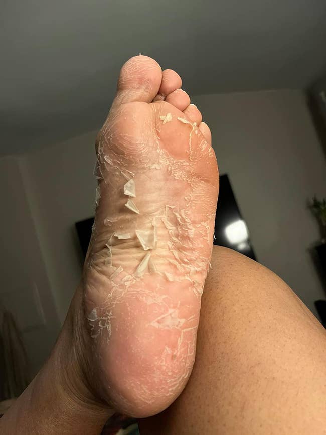reviewer's foot with peeling dead skin