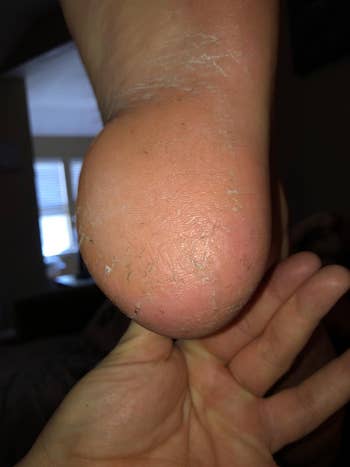 Close-up of the aforesaid  person's bottommost   showing betterment  with little  cracked skin