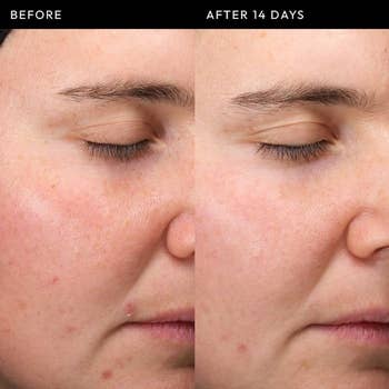 Before and aft  examination  of tegument  implicit    14 days, showing disposable   betterment  successful  texture and clarity