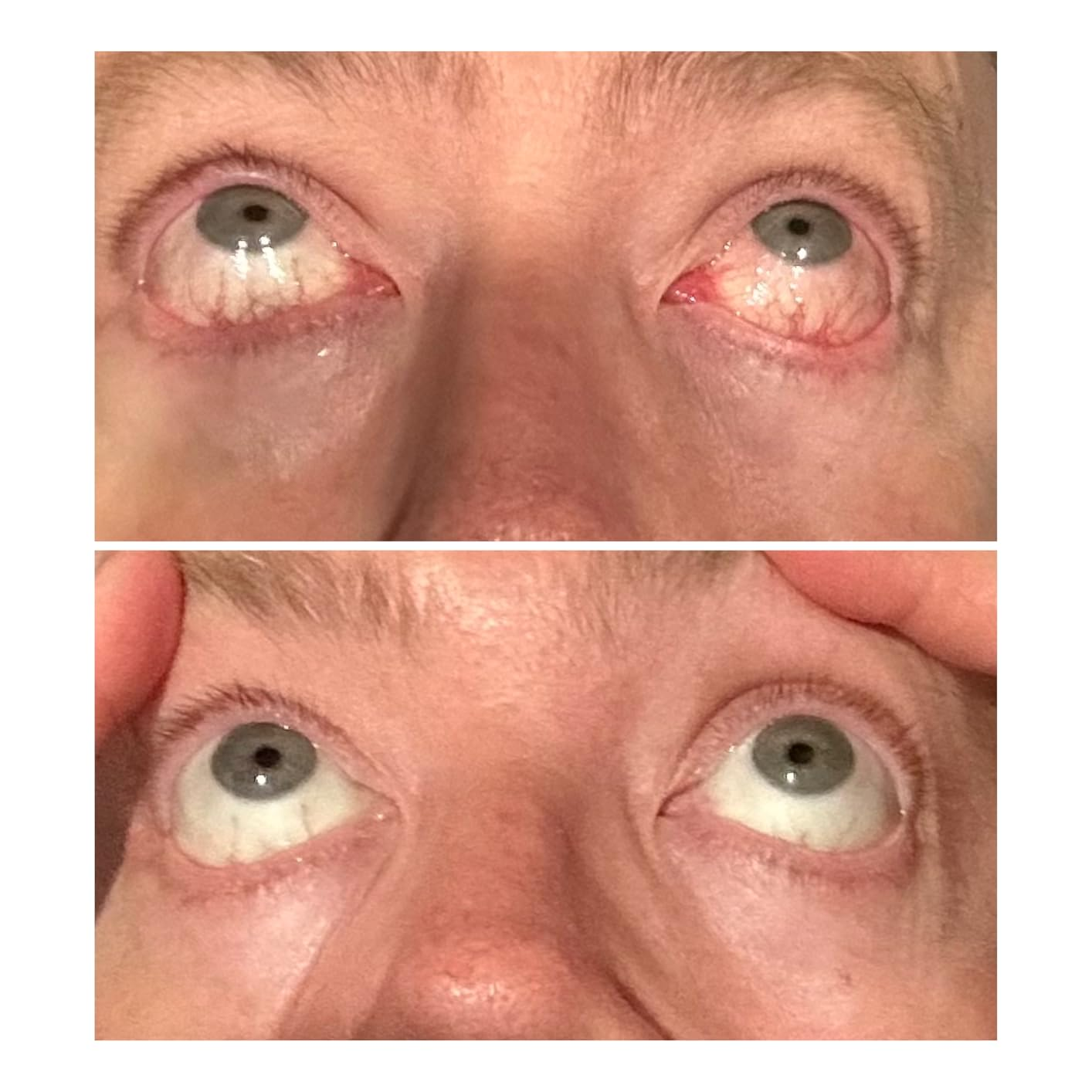 Close-up of eyes looking upwards, showing differences successful  eyelid position, perchance  related to a cosmetic oregon  wellness  merchandise  context