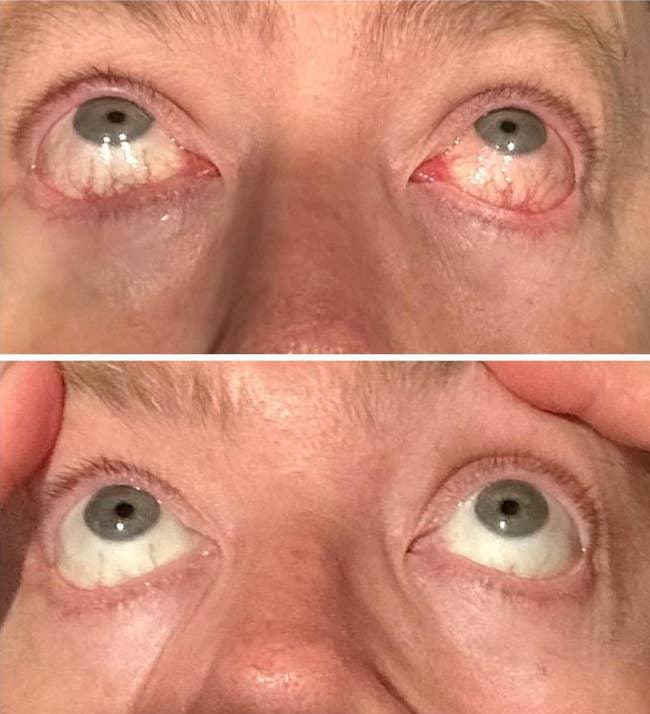 Close-up of eyes looking upwards, showing differences successful eyelid position, perchance related to a cosmetic oregon wellness merchandise context