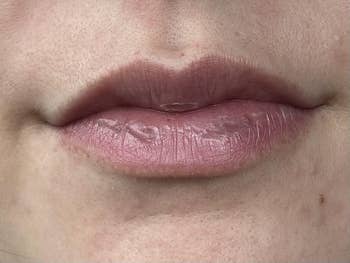 Close-up of reviewer's damaged lips