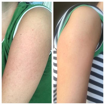 reviewer side by side of their bumpy skin and their smooth, even skin after using the product