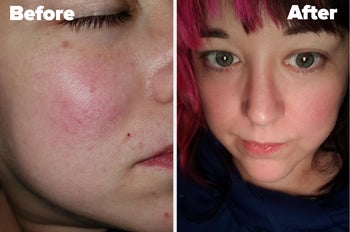 reviewer side by side of their red skin and their skin with reduced redness
