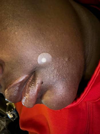 Person with a circular acne spot connected their cheek, suggesting usage of skincare product