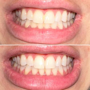 top: reviewer before photo of teeth with slight yellowing and debris in between / bottom: after photo of teeth looking whiter with less debris in between