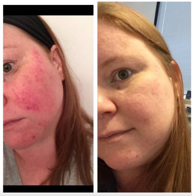 reviewer shows how it spray helped their rosacea