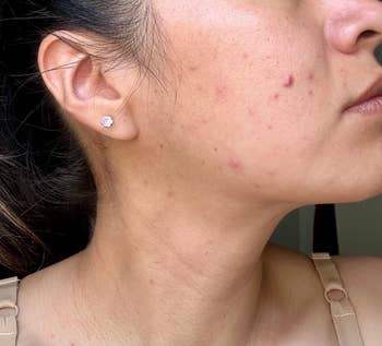 Close-up of a person's cheek with visible acne and blemishes, wearing a small earring and thin strapped top