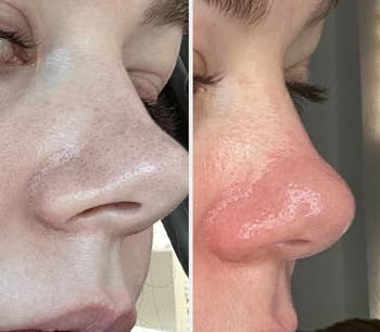 Close-up of a reviewer's nose before and after the patch
