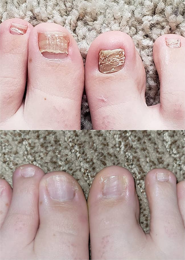 Close-up of toenails before and after treatment, showing improvement from thick, rough nails to smooth, healthy ones