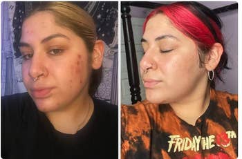 Reviewer's skin before and after using vitamin C serum