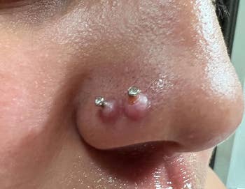 reviewer before photo of double nostril piercing with inflamed keloid bump