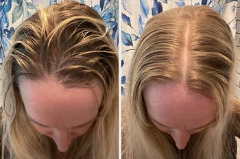 Before and after photos of a person's scalp showing greasy hair and then clean hair