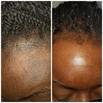 b&a of reviewer's forehead with uneven tone and dark spots (left) and same forehead with a more glowy look (right)