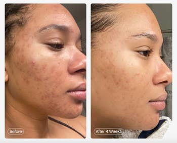 model's before and afters with acne and red spots on the left and visibly clearer skin on the right