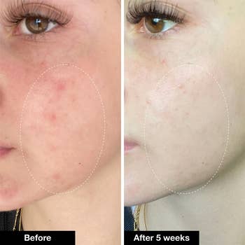 a before and after of a person's facial acne clearing up after 5 weeks of use