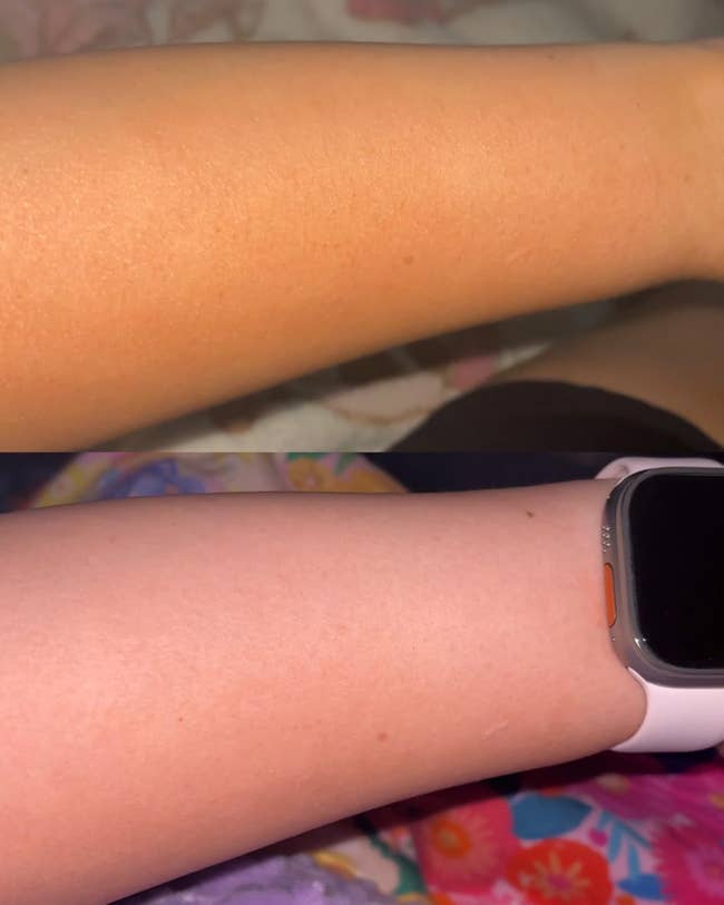 Two forearms shown earlier and aft utilizing a tan removal