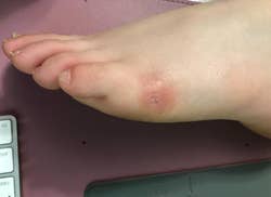 reviewer's healed foot