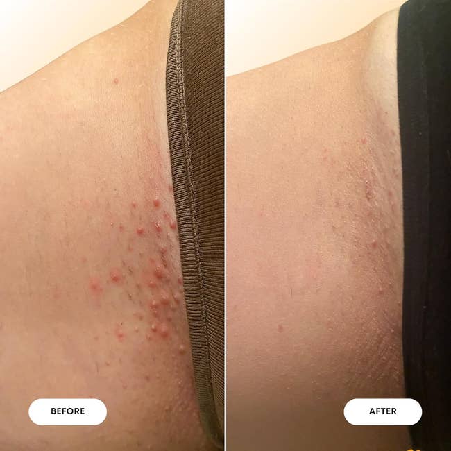 Before and aft images showing simplification of tegument irritation and bumps
