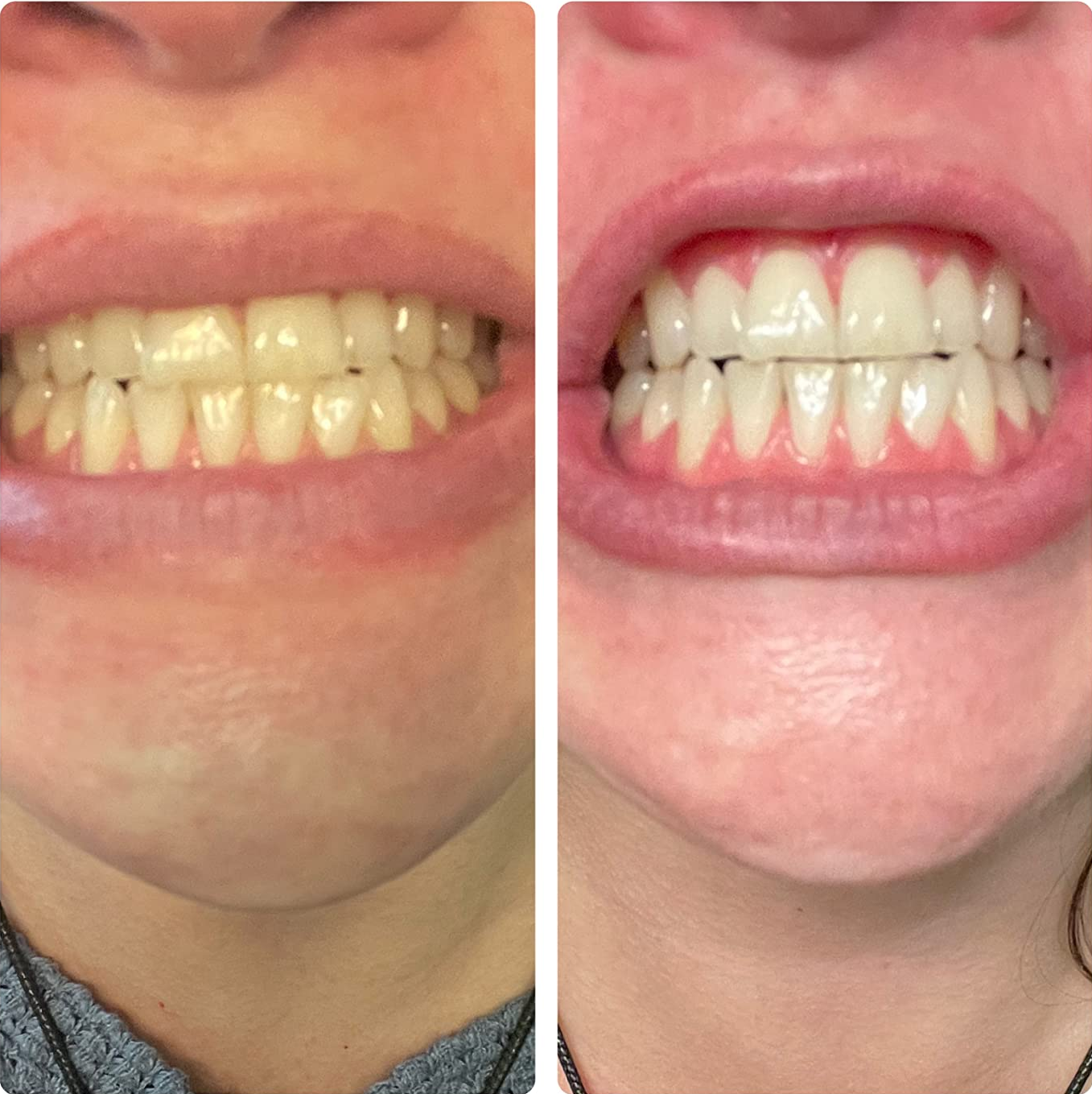 split image of reviewer's teeth before and after using whitening pen with teeth much whiter after