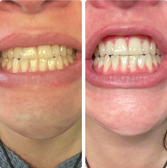 split representation of reviewer's teeth earlier and aft utilizing whitening pen with teeth overmuch whiter after