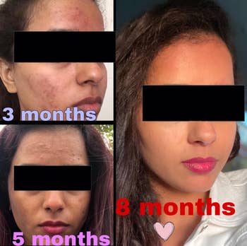 Four-part image showing a reviewer's skincare progress over 3, 5, and 8 months