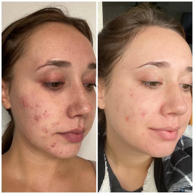 a before and after comparison of a reviewer with a lot of acne, and the same reviewer with far less acne