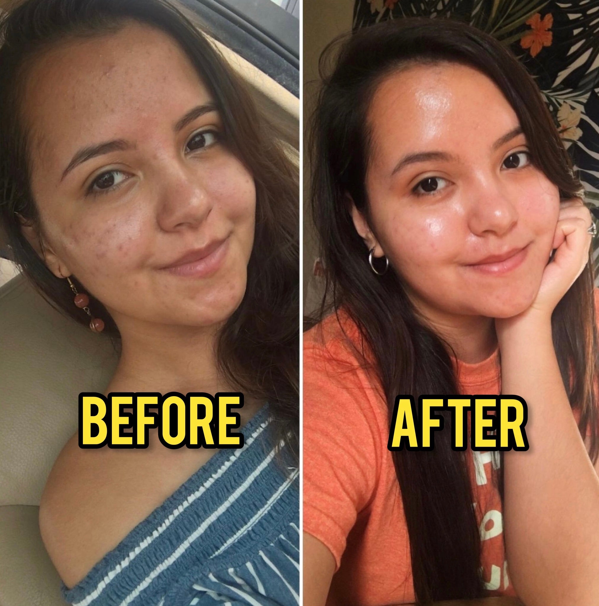 Watch the progress! This guest has struggled with hyperpigmentation and  breakouts most of her life. Her goal was to clear up her skin thi