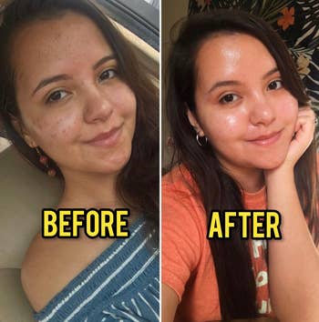 A reviewer's before and after showing reduced acne marks and clearer, glowing skin