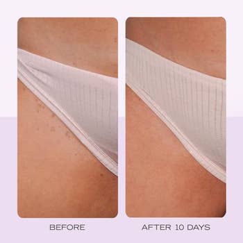 Side-by-side examination  of tegument  earlier  and aft  10 days, showing improved texture and simplification  successful  spots