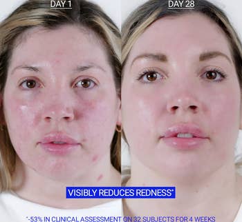 before and after of a user's red skin, to more even skin tone post-use
