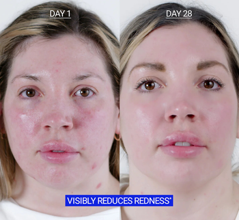 before and after of a user's red skin, to more even skin tone post-use