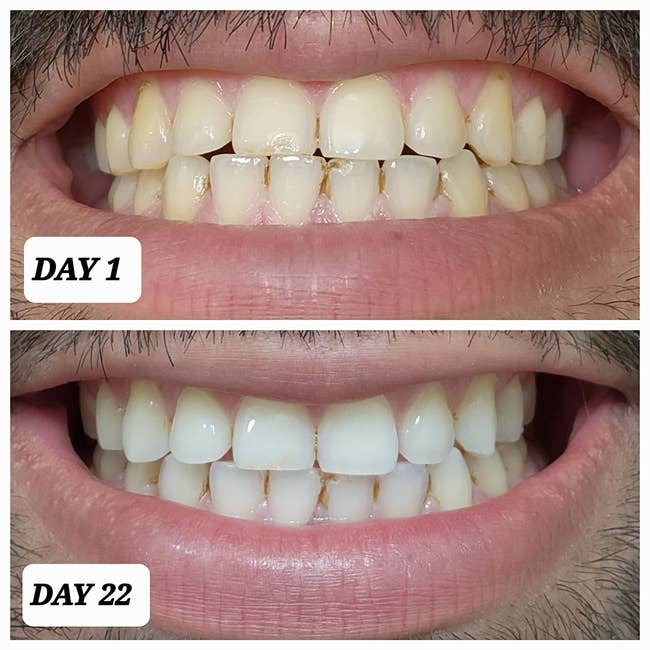 a reviewer's before and after whitening their teeth with crest 3d white strips