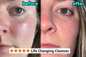 Before and aft  images showing improved tegument  texture and reduced redness with 