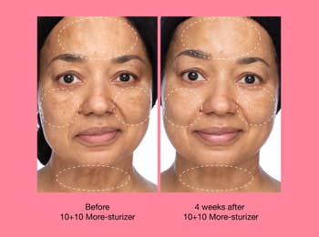 on left: model with slight hyperpigmentation around face. on right, same model with less hyperpigmentation spots after using the moisturizer for four weeks